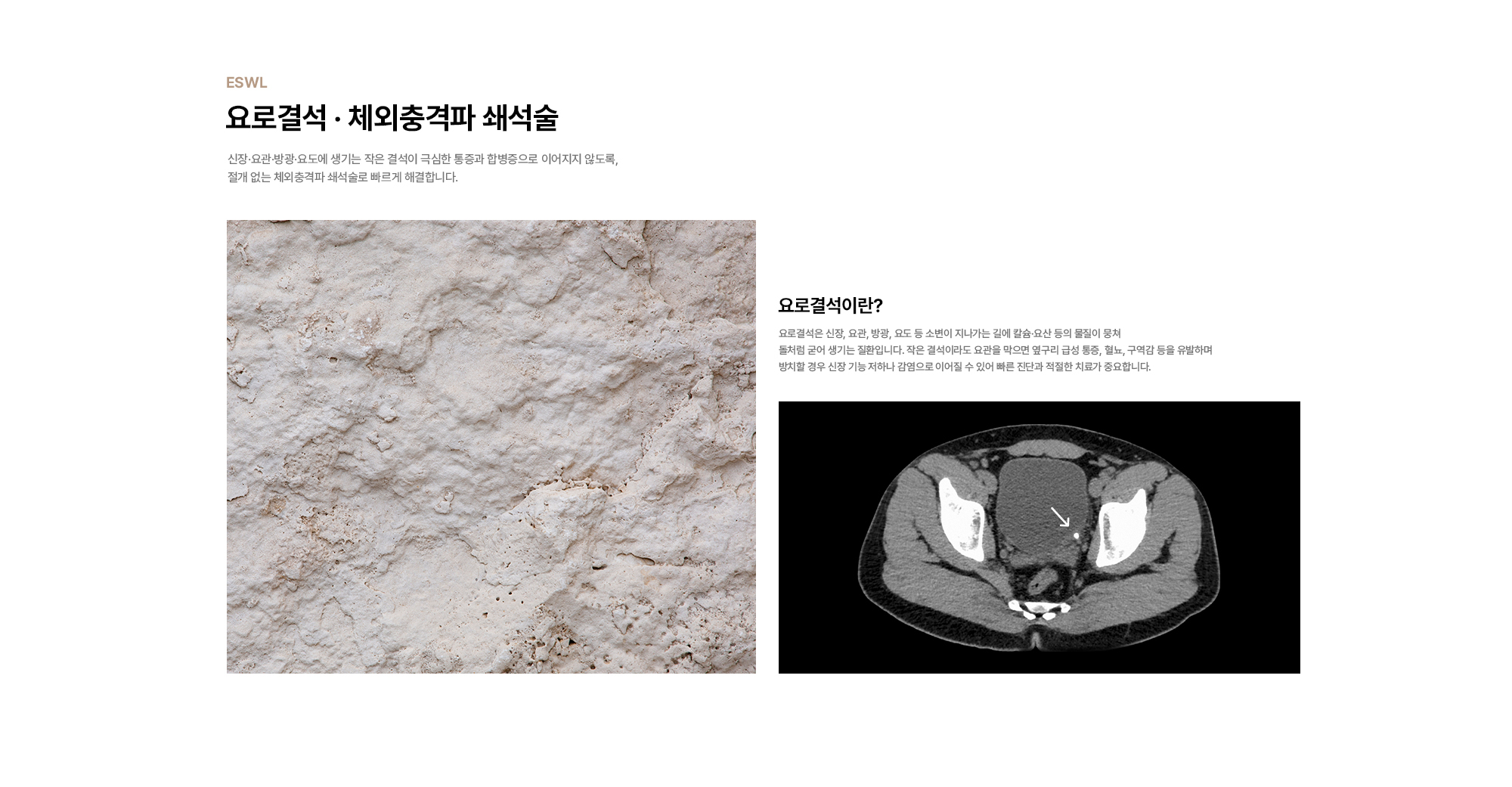[요로결석 · 체외충격파 쇄석술] 신장·요관·방광·요도에 생기는 작은 결석이 극심한 통증과 합병증으로 이어지지 않도록, 절개 없는 체외충격파 쇄석술로 빠르게 해결합니다. [요로결석이란?] 요로결석은 신장, 요관, 방광, 요도 등 소변이 지나가는 길에 칼슘·요산 등의 물질이 뭉쳐 돌처럼 굳어 생기는 질환입니다. 작은 결석이라도 요관을 막으면 옆구리 급성 통증, 혈뇨, 구역감 등을 유발하며 방치할 경우 신장 기능 저하나 감염으로 이어질 수 있어 빠른 진단과 적절한 치료가 중요합니다.