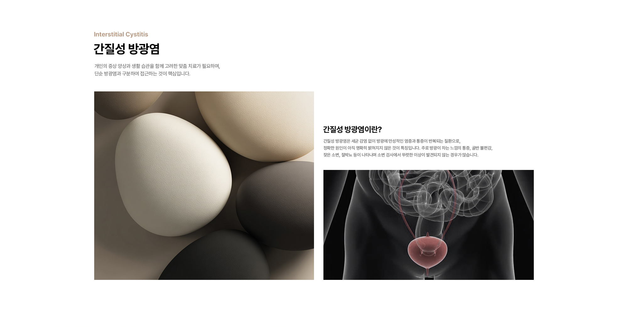 
        간질성 방광염 : 개인의 증상 양상과 생활 습관을 함께 고려한 맞춤 치료가 필요하며, 단순 방광염과 구분하여 접근하는 것이 핵심입니다.
        간질성 방광염이란? 간질성 방광염은 세균 감염 없이 방광에 만성적인 염증과 통증이 반복되는 질환으로, 정확한 원인이 아직 명확히 밝혀지지 않은 것이 특징입니다.
        주로 방광이 차는 느낌의 통증, 골반 불편감, 잦은 소변, 절박뇨 등이 나타나며 소변 검사에서 뚜렷한 이상이 발견되지 않는 경우가 많습니다.